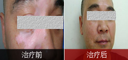 男性面部散发型白癜风1年
