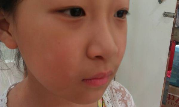 解析儿童脸上长白斑的原因